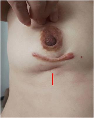 Myofibroblastic sarcoma in breast: a case report and literature review